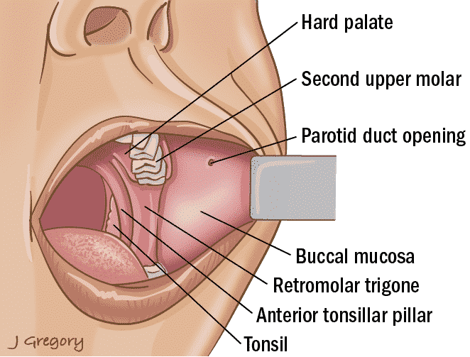 Mouth Cancer Image